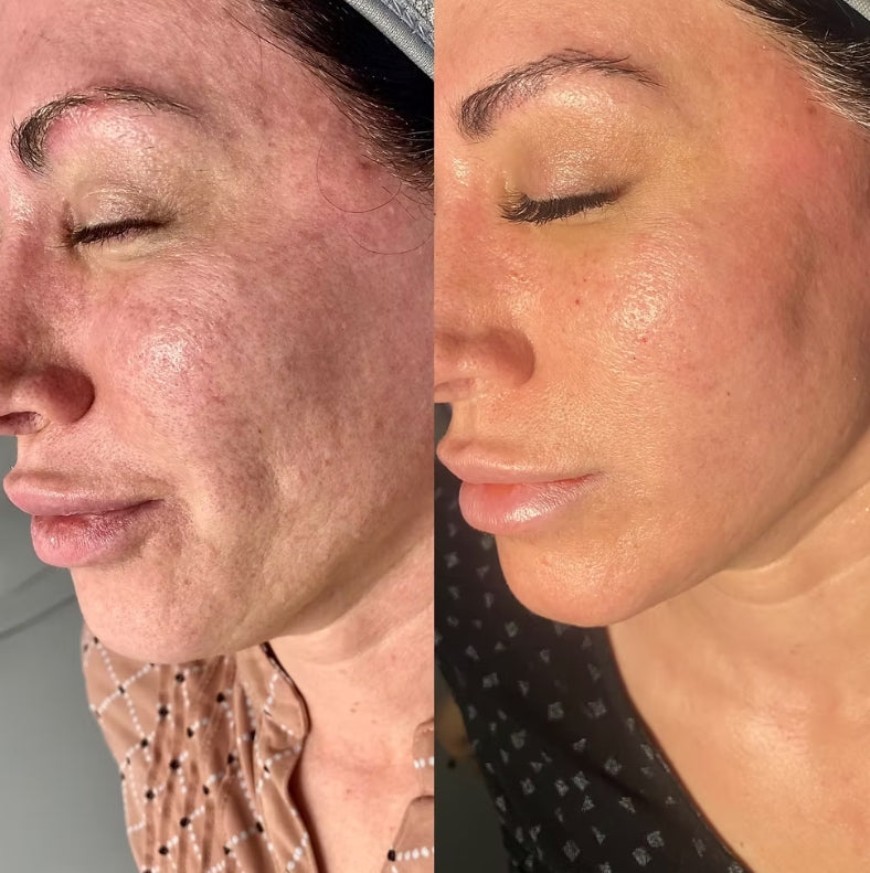 LED Red Light Therapy Mask