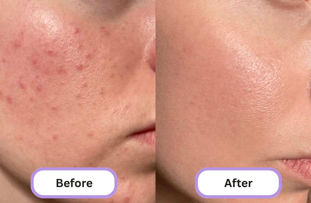 TherapyLight Facial and Neck Massage Tool